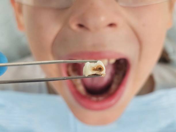 Best Same-Day Emergency Dentist in Park City, MT